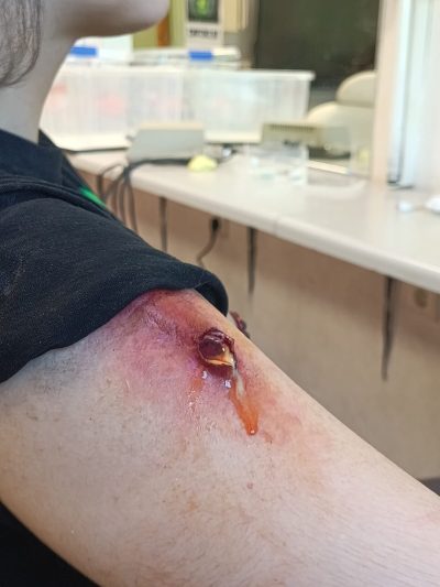 Herida infectada FX: prótesis de silicona con supuración y textura orgánica